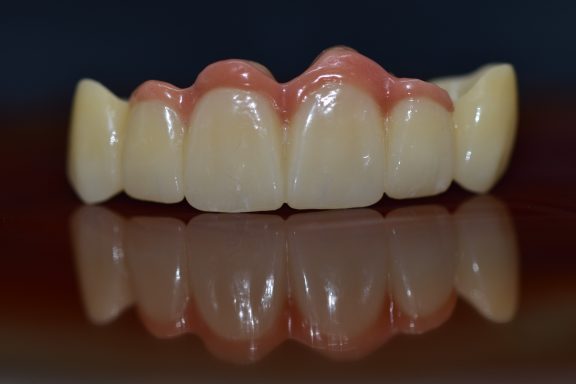 puente de zirconio monolítico