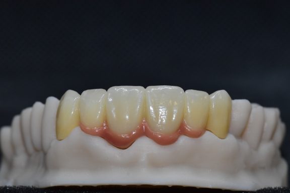 zirconio monolitico con encia rosa