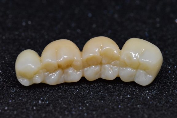 puente de zirconio monolítico