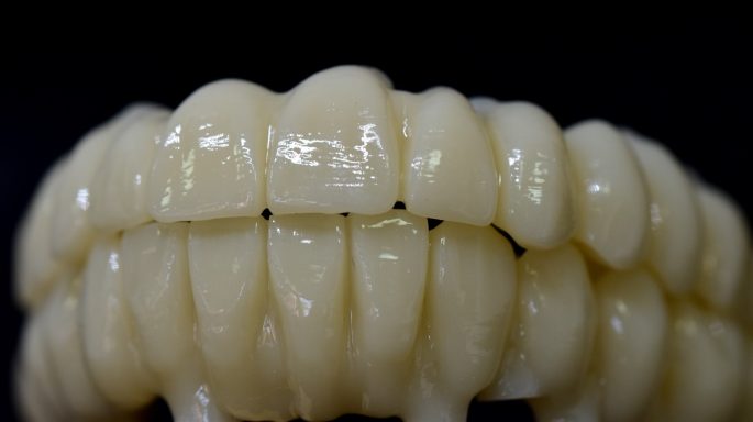 Provisional pmma sobre implantes